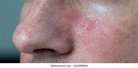 Psoriasis Allergic Rash On Skyn Face Stock Photo 1642998904 | Shutterstock