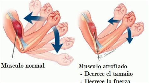 ATROFIA MUSCULAR - O QUE É, CAUSAS, SINTOMAS E TRATAMENTO - YouTube