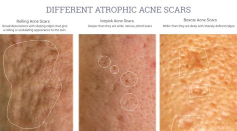 The Different Types of Atrophic Acne Scars - Art of Dermatology | New York