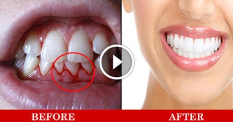 Home Remedies For Bleeding Teeth - Must Watch ~ Entertainment News ...