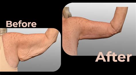 Arm Lift Surgery Before and After Photos | Avicenna Hospital