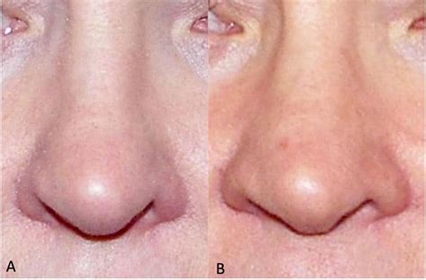 Surgical Management of Nasal Airway Obstruction - Larry M. Wolford, DMD