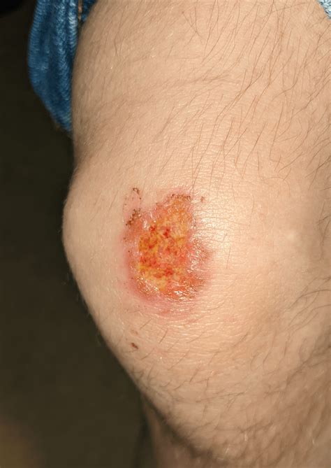 Next steps for healing an infected scrape? : r/woundcare