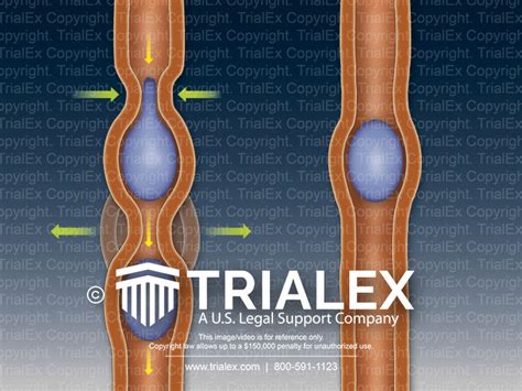 Peristalsis - TrialExhibits Inc.