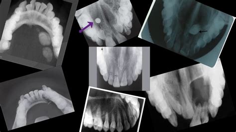 The Purpose Of The Occlusal Technique - Occlusal Radiographs - YouTube