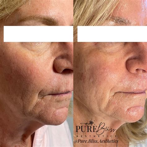 PRX Derm Perfexion Before And After — Pure Bliss Aesthetics