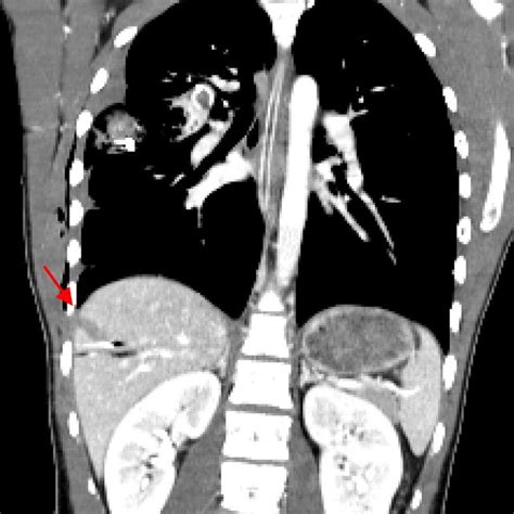 Chest radiography exhibiting left diaphragmatic elevation, an indirect... | Download Scientific ...