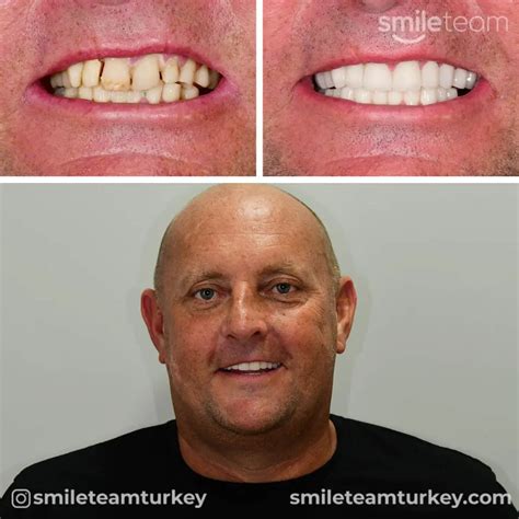 Turkey Teeth Before After Photos | Smile Team Turkey