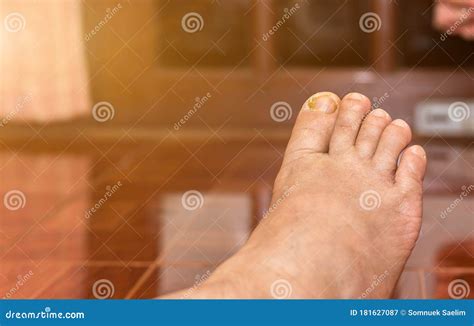 Nail Sores on the Toes,healthy and Healthcare Concept Stock Image ...