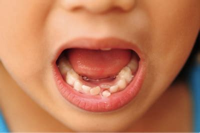 What are SHARK TEETH and should I be worried? - Kiddies Dental Care