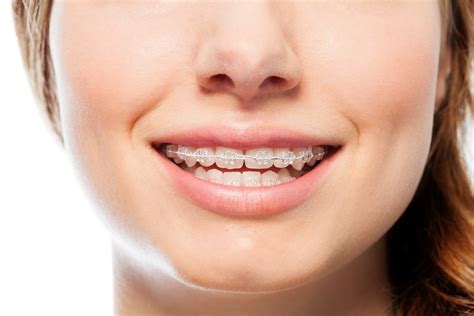 How Long Do You Have to Wear Braces? | Koen Orthodontics