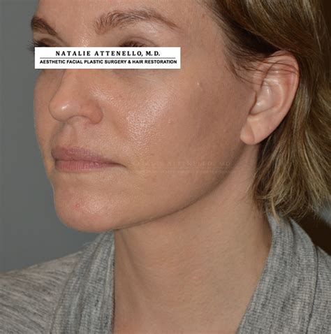 Beverly Hills Facelift Before and After Photos - Los Angeles Plastic ...