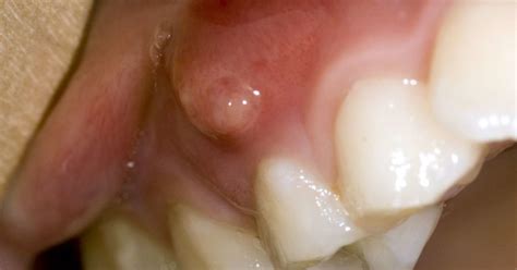 Gum boils: What they are and how to treat them