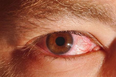 Causes and Treatments of Eye Discharge - Facty Health