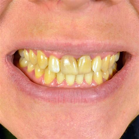 Just How To Eliminate Dental Caries: 6 Natural Home Remedy