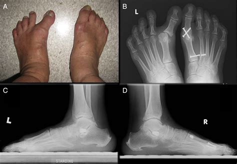 Spontaneous Subtalar Fusion: An Irreversible Complication of Subtalar Arthroereisis - The ...