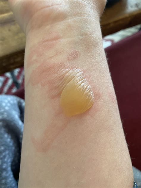 Burn blister...the most forbidden pop I have ever had... 😖 : r/popping