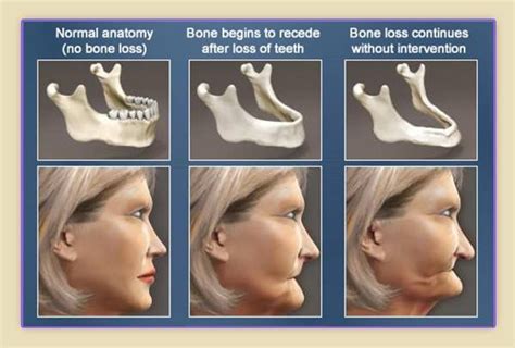 The most common cause of bone loss is tooth loss left un-replaced, especially multiple teeth ...