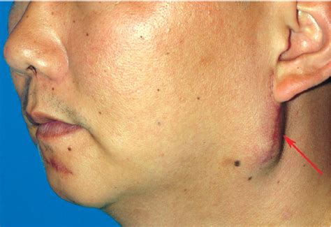 Figure 4 from Treatment of intractable parotid sialocele occurred after open reduction-fixation ...