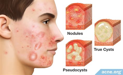 What Is Cystic Acne? - Acne.org