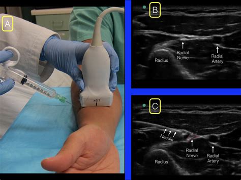 Forearm blocks — Highland EM Ultrasound Fueled pain management