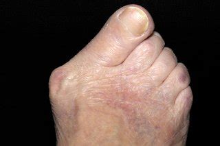 Bunions - NHS