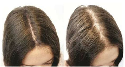 What's Female Pattern Hair Loss Pictures | Hairstyles Ideas