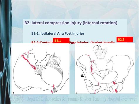 Pelvic fracture classification