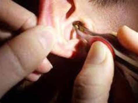 Ear Wax Removal Nottingham - Happy Ears Clinic Nottingham