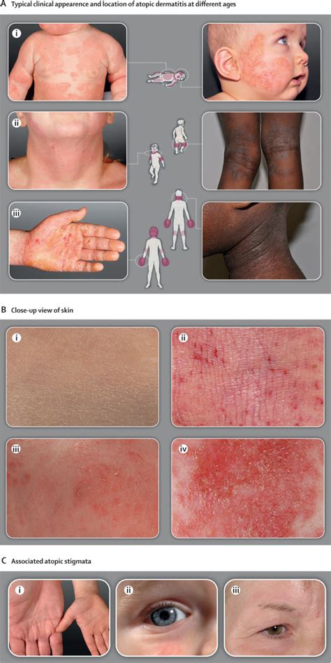 Atopic dermatitis - The Lancet