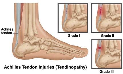 Achilles Tendonitis Treatment & Recovery - Foot Pain Explored