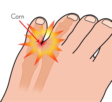 Corn between the 4th and 5th toes | Dubai Podiatry Centre