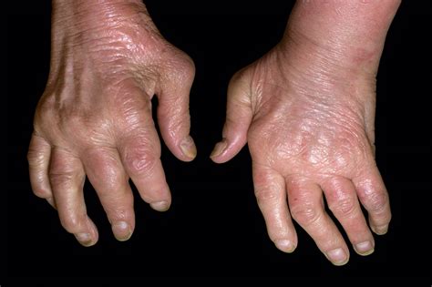 Psoriatic Arthritis Remission Compared With Very Low Disease Activity, DAPSA Criteria ...