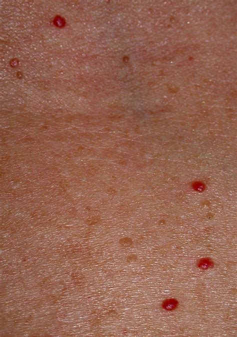 Small Flat Red Spots On Skin | Images and Photos finder