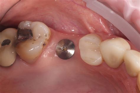 The benefits of tissue level implants restoratively - ITI Blog