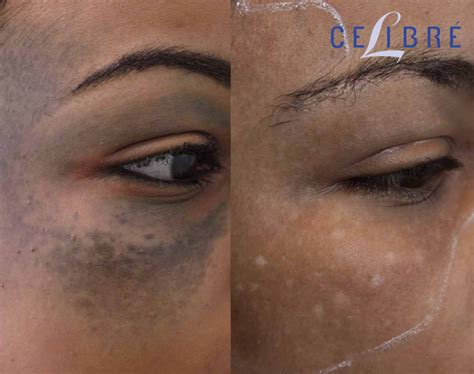 Birthmark Removal Before and After Pictures