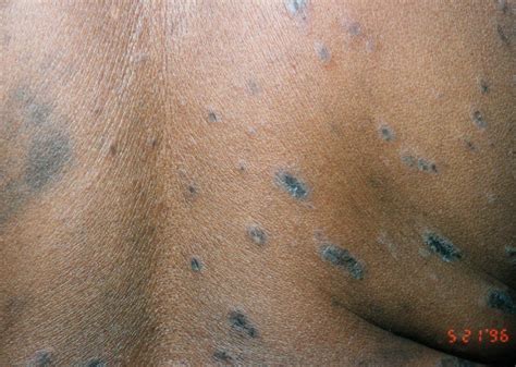 Mild Pityriasis Rosea