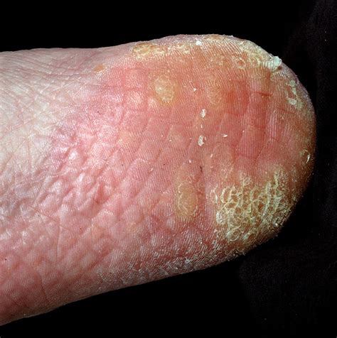 Viral Warts Symptoms