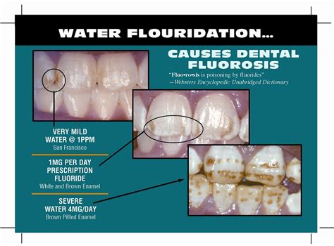 Three Stages of Dental Fluorosis | Great pictures showing th… | Flickr