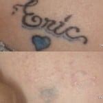 Laser Tattoo Removal in Minneapolis - Edina - Plymouth | Zelskin.com