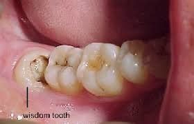 Wisdom Tooth Pain Relief - Pain Relief for Wisdom Teeth Naturally - Hawaii Dental ... : Most of ...