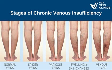 The Stages Of Chronic Venous Insufficiency (CVI)