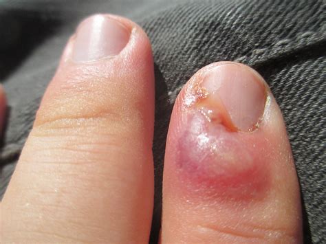 ingrown fingernail – Richard T. Reilly