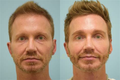 Dallas Facial Hair Restoration Before and After Photos - Plano Plastic ...