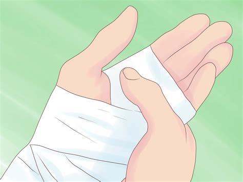 How+to+Treat+a+Hand+Burn+--+via+wikiHow.com 2nd Degree Burns Treatment ...