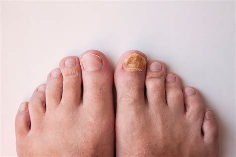 best way to get rid of toenail fungus naturally - Toenail Fungus Treatment | Toenail Fungus ...
