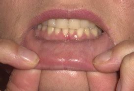 Treatment of pyostomatitis vegetans with topical tacrolimus - Journal of the American Academy of ...