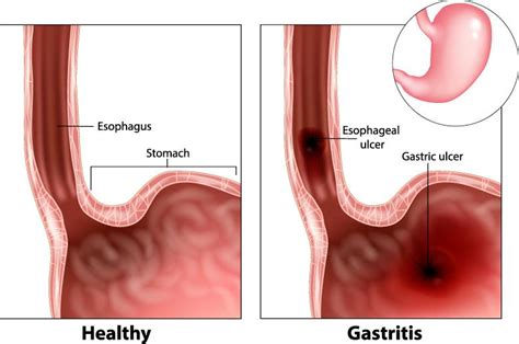 Gastritis - Causes, Symptoms & Signs | Gleneagles Hospital