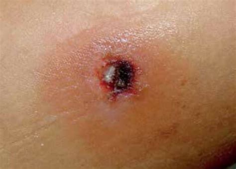 Pseudomonas Aeruginosa Skin Infection