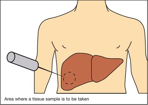 Biopsy is a sample of tissue taken from the body in order to examine it closer. | Liver care ...